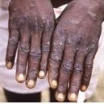 Epidémie de la variole du singe: Le ministère a déjà élaboré un protocole en cas de suspicion d’infection de la maladie dans le pays…